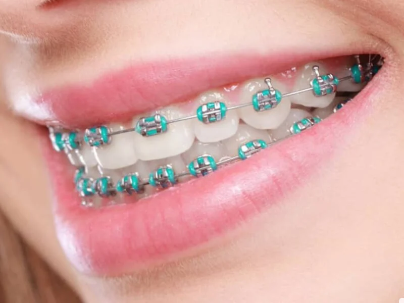 نحوه مراقبت از رنگ ارتودنسی