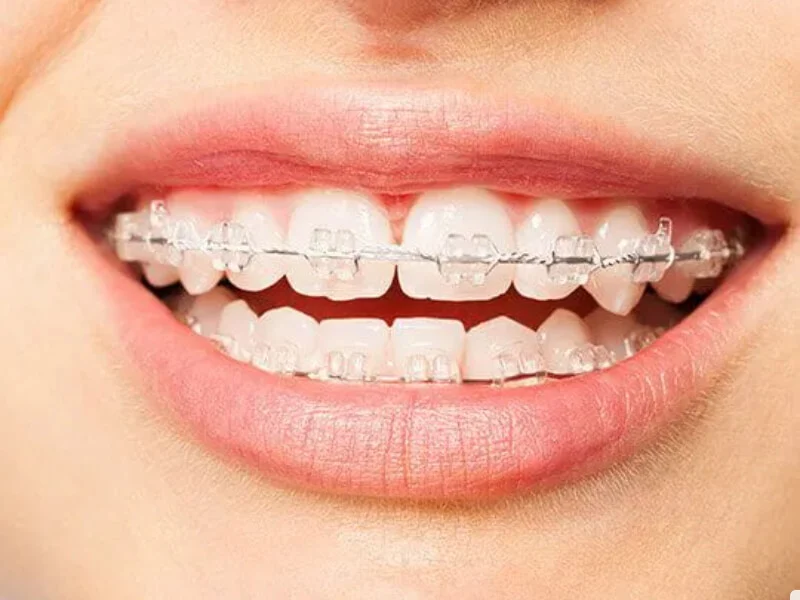 عوامل تأثیرگذار در انتخاب رنگ ارتودنسی