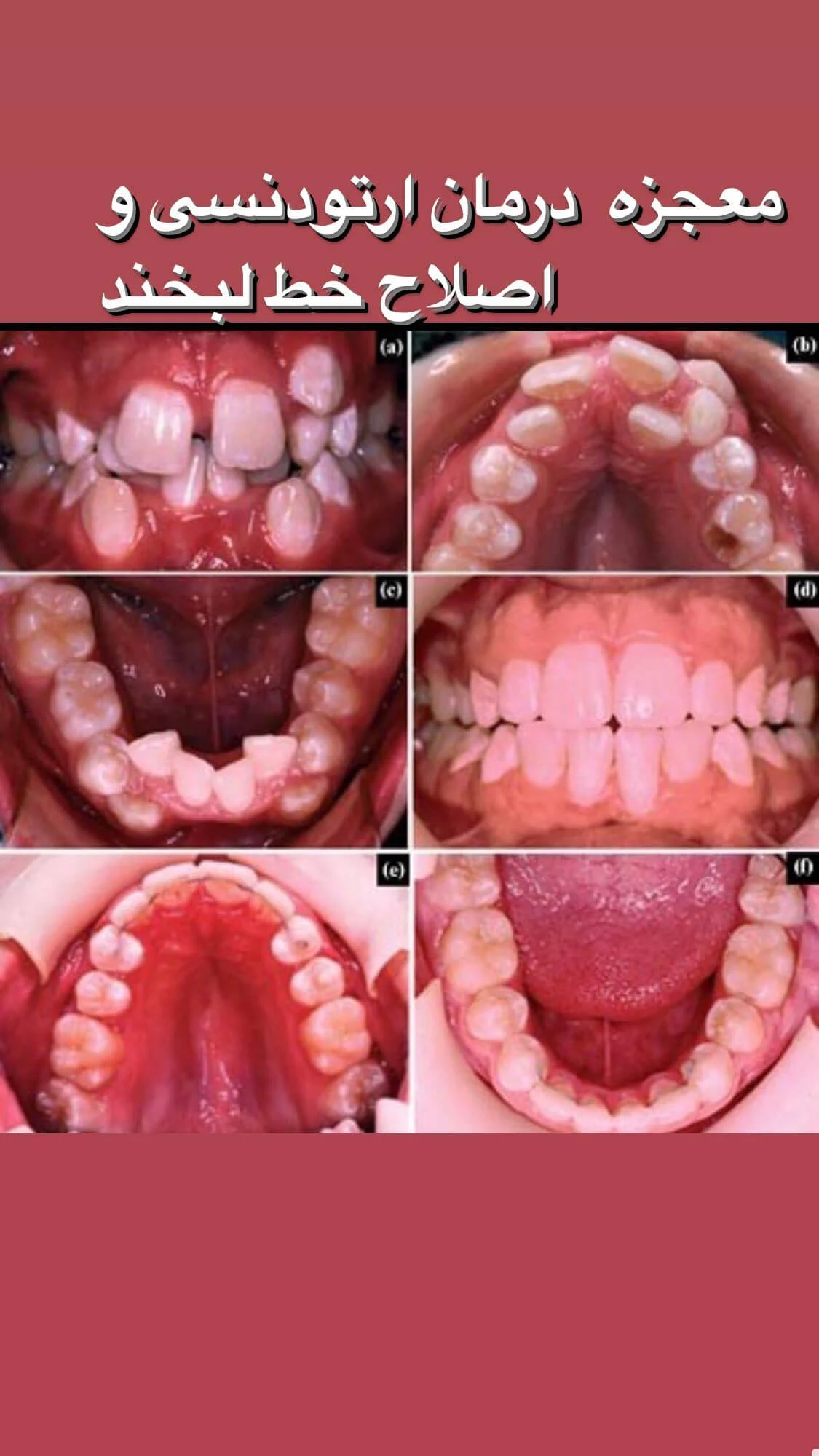 نمونه کار ارتودنسی دکتر سعید فلاح زاده