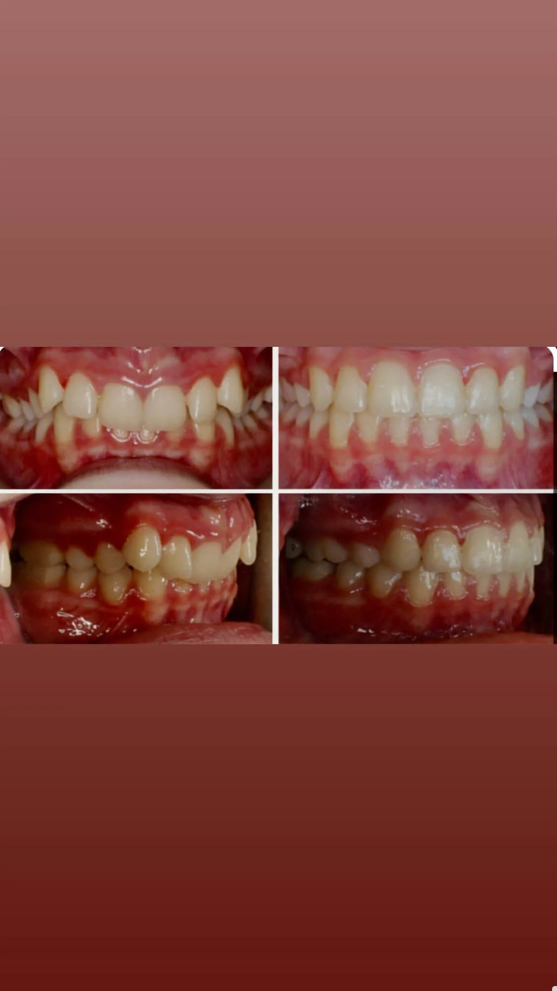 نمونه کار ارتودنسی دکتر سعید فلاح زاده