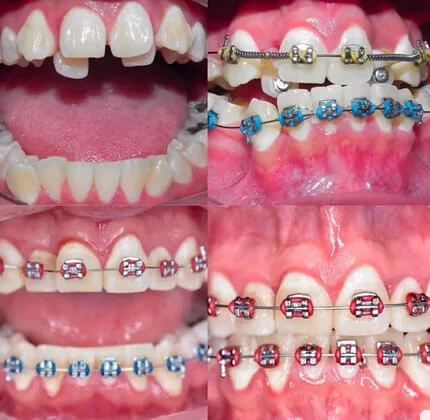 نمونه کار ارتودنسی دکتر سعید فلاح زاده