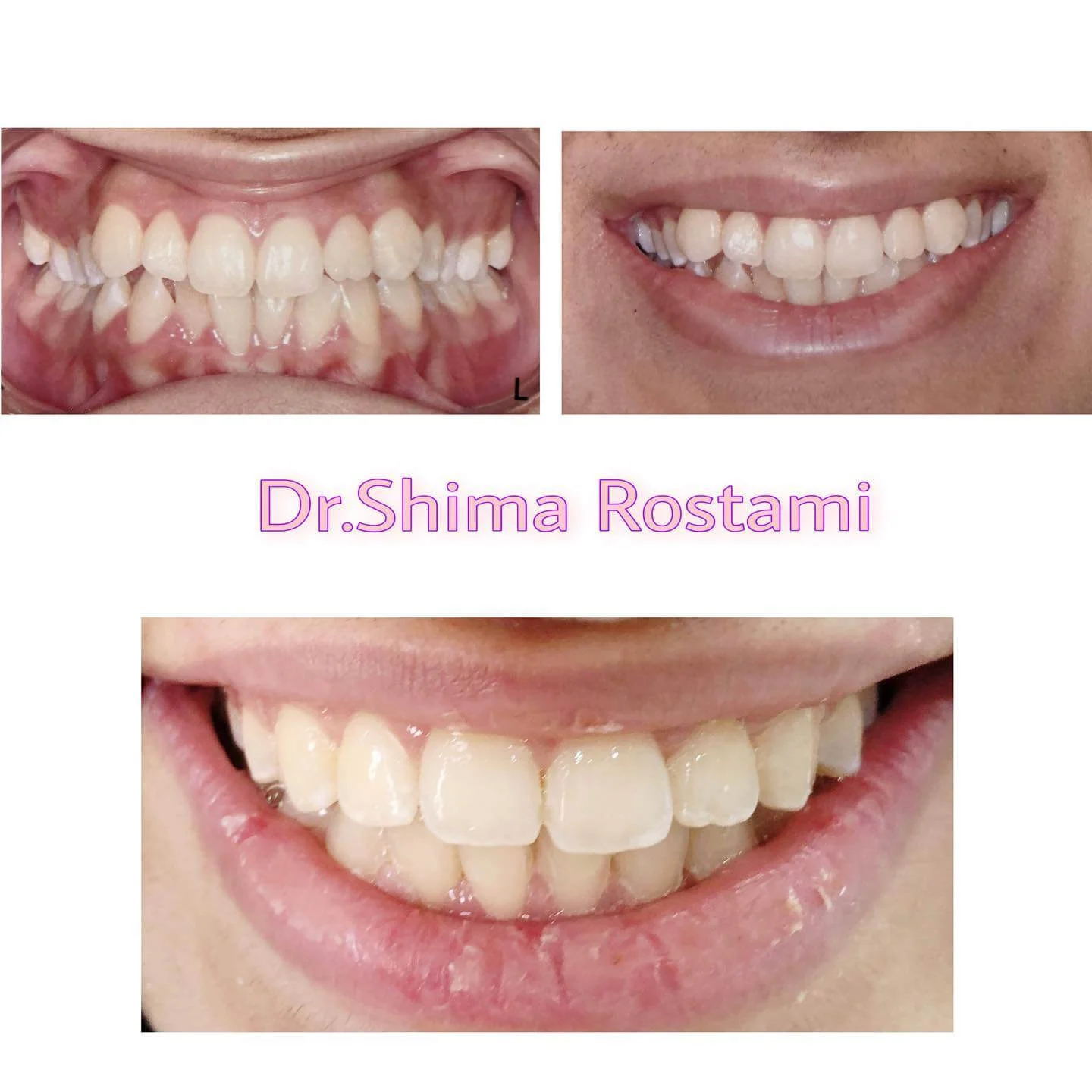 نمونه کار ارتودنسی دکتر شیما رستمی