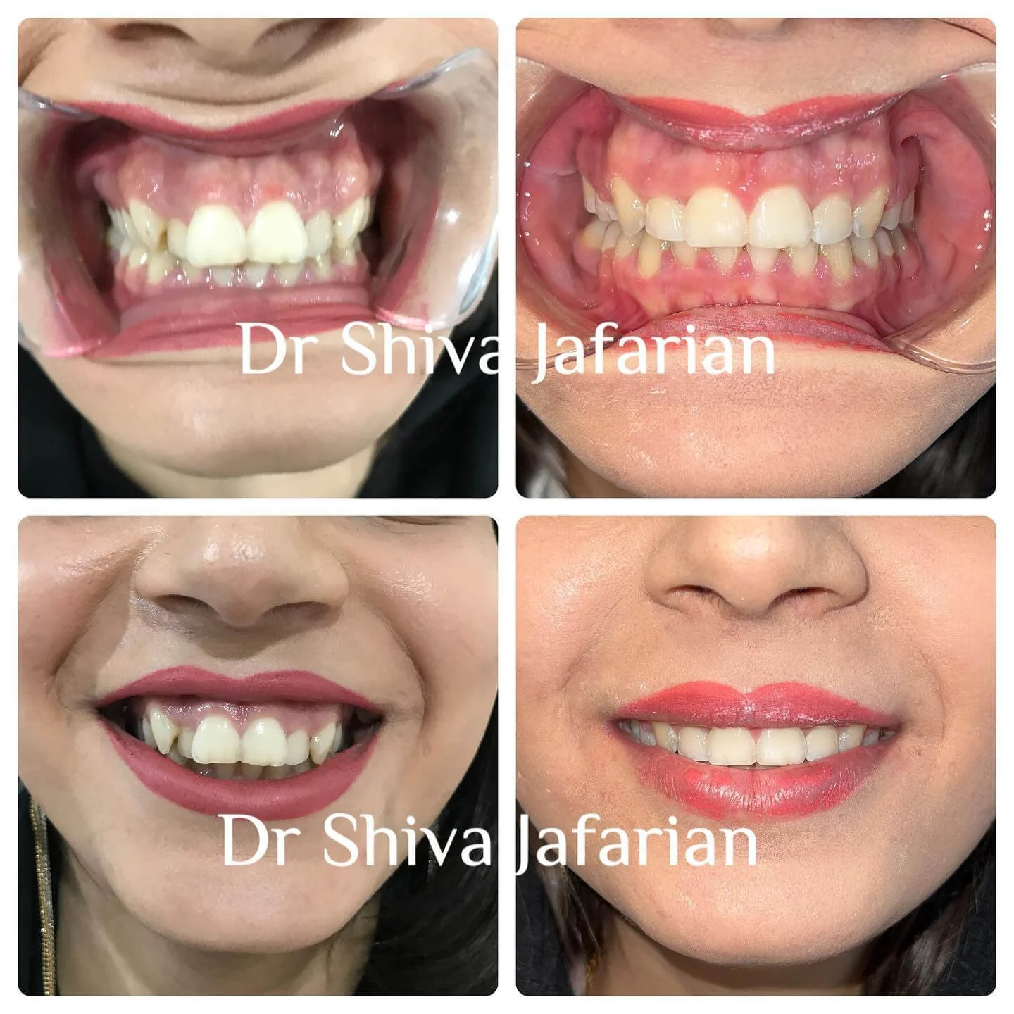 نمونه کار ارتودنسی دکتر شیوا جعفریان