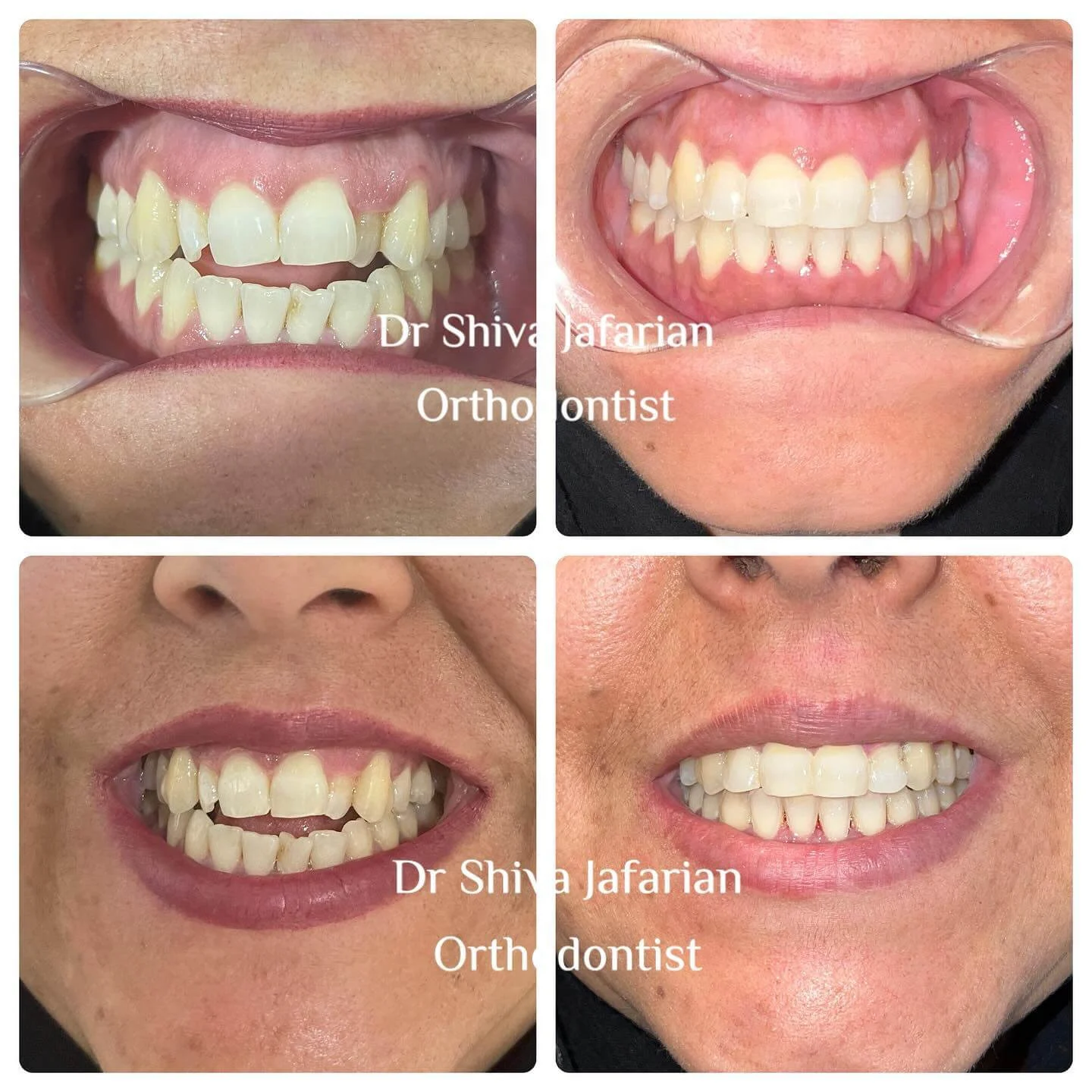 نمونه کار ارتودنسی دکتر شیوا جعفریان