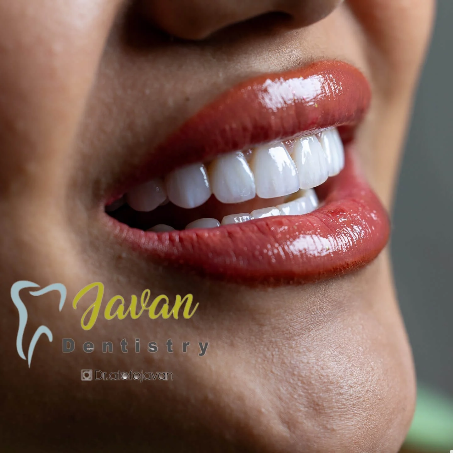 نمونه کار ارتودنسی دکتر عاطفه صادقیان جوان