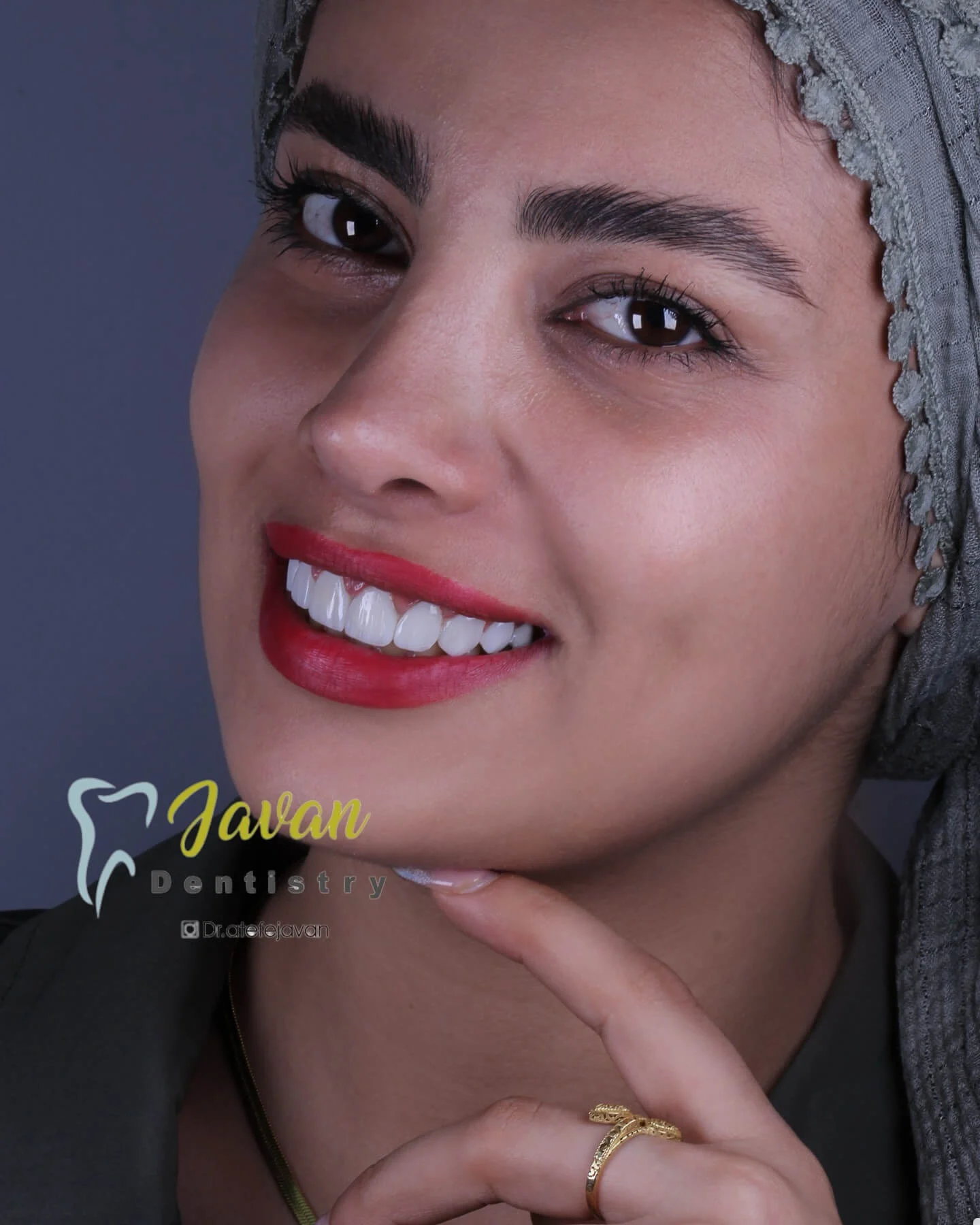 نمونه کار ارتودنسی دکتر عاطفه صادقیان جوان