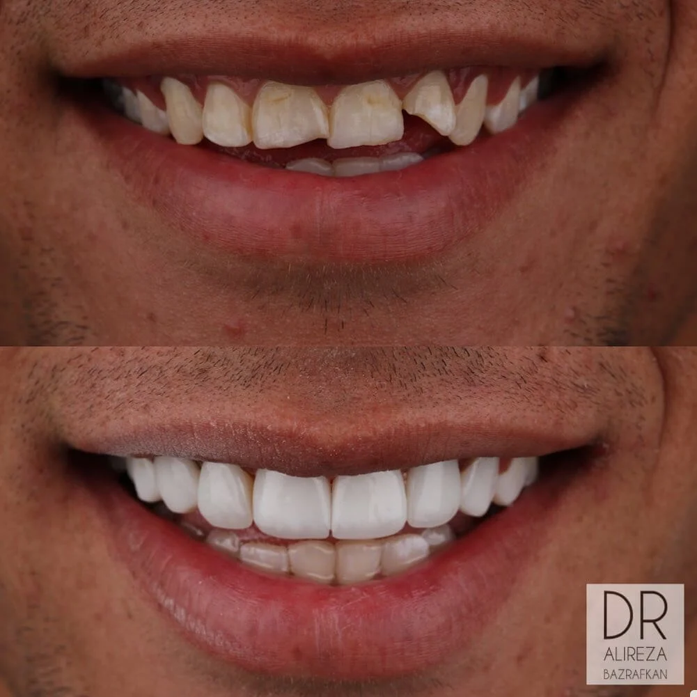 نمونه کار ارتودنسی دکتر علیرضا بذرافکن