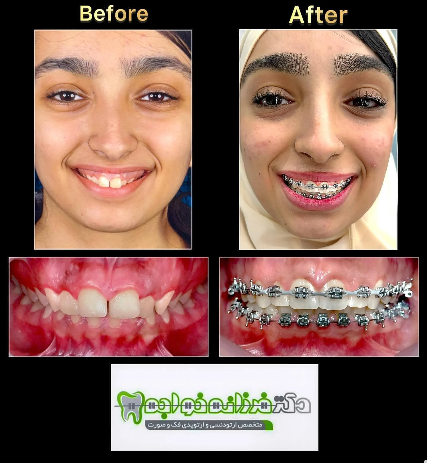 نمونه کار ارتودنسی دکتر فرزانه خواجه