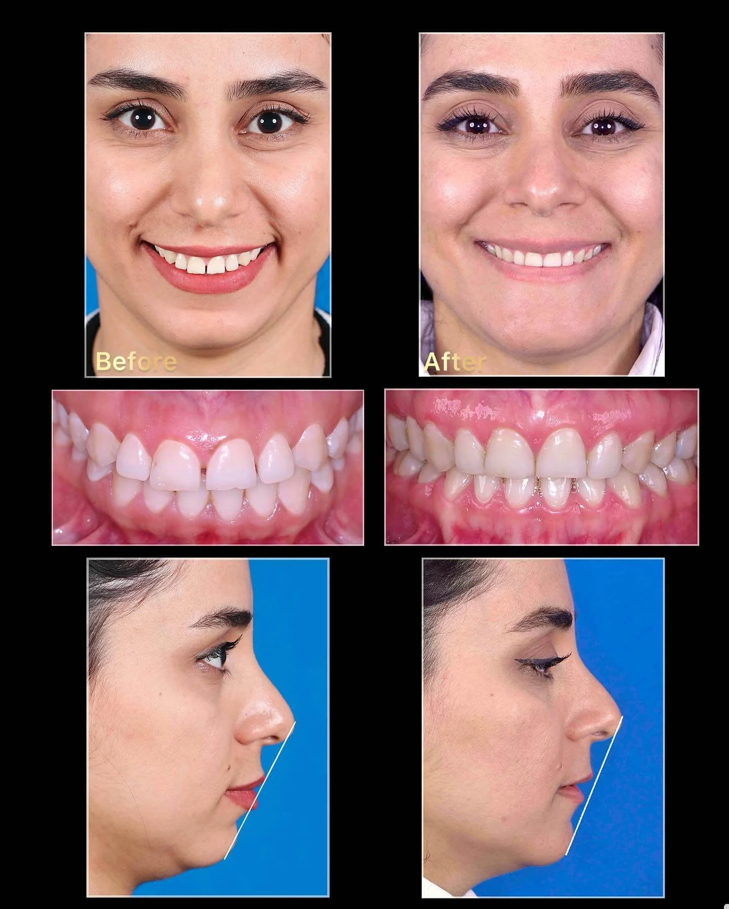 نمونه کار ارتودنسی دکتر فرزانه خواجه