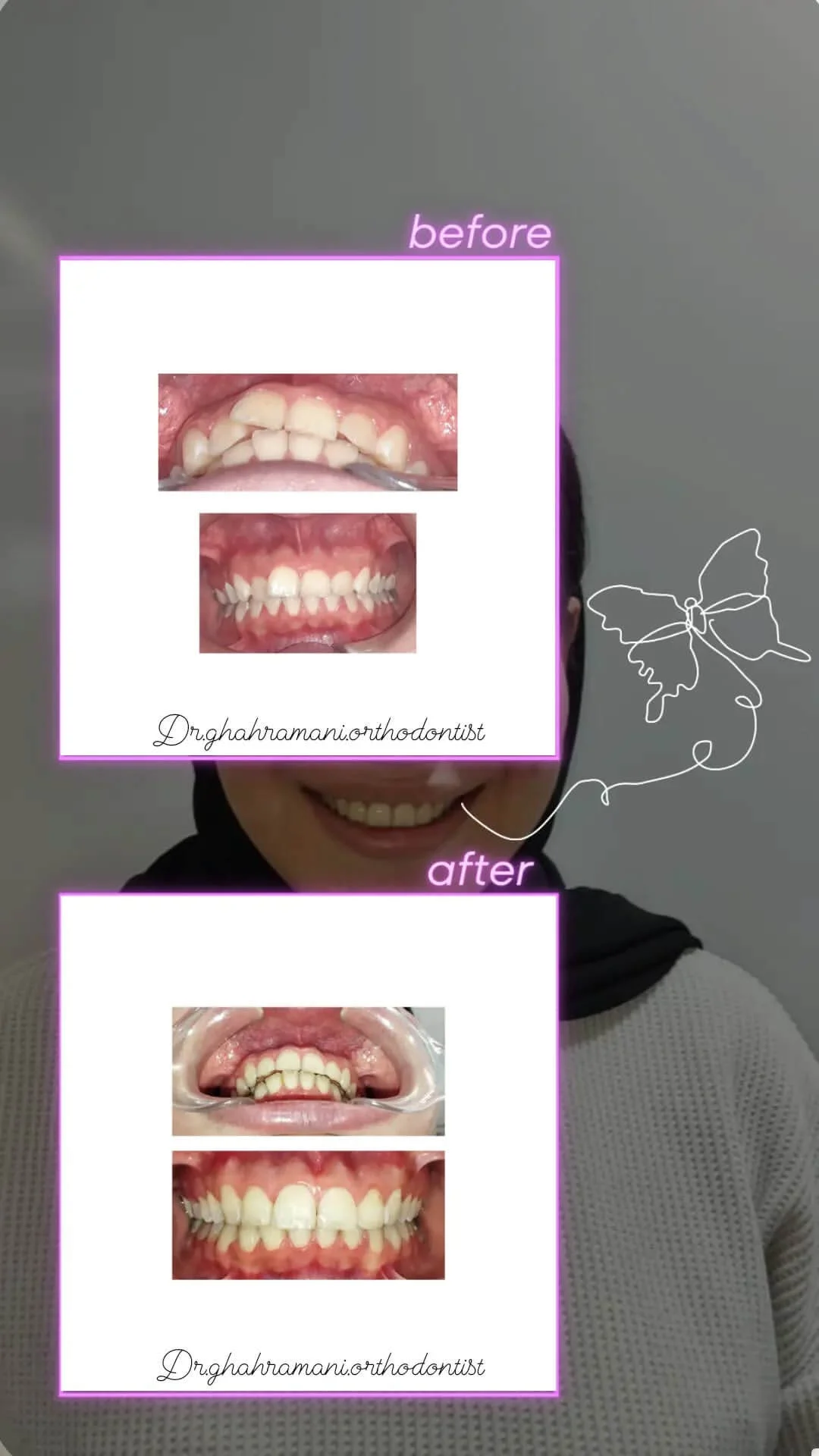 نمونه کار ارتودنسی دکتر مهدیه قهرمانی