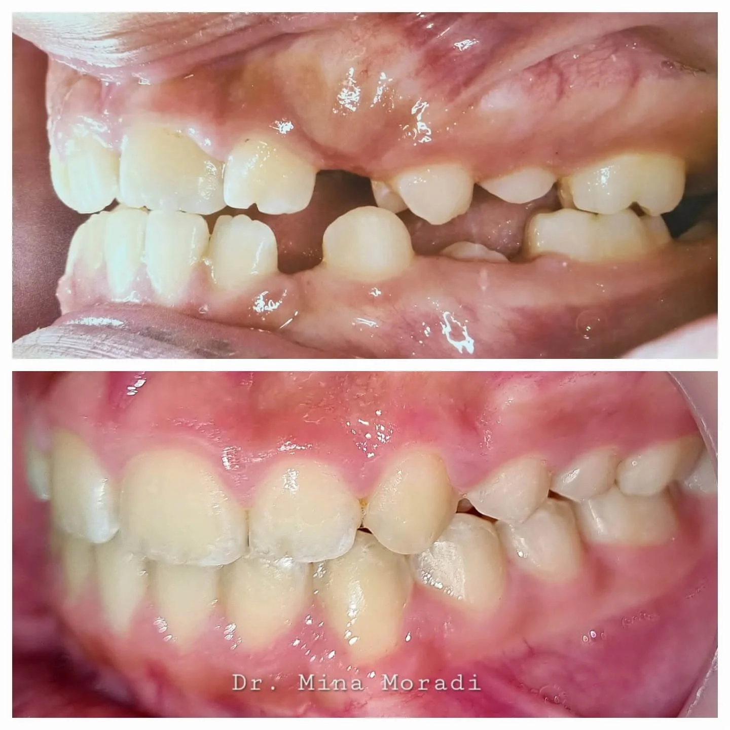 نمونه کار ارتودنسی دکتر مینا مرادی