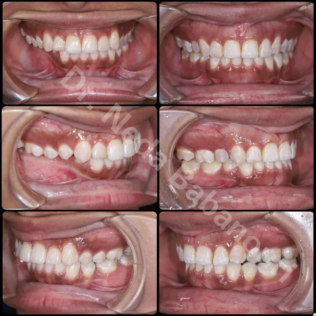 نمونه کار ارتودنسی دکتر ندا بابانوری