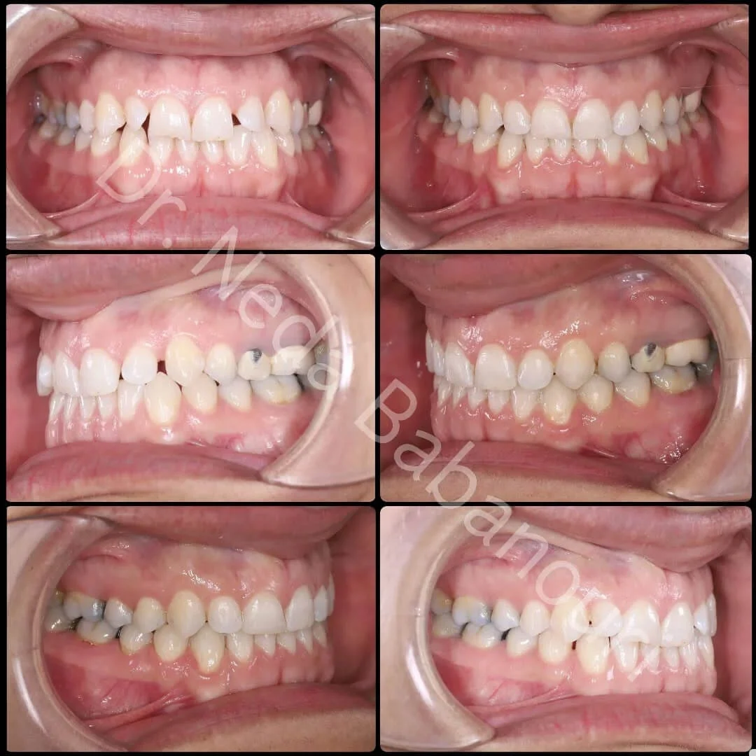 نمونه کار ارتودنسی دکتر ندا بابانوری