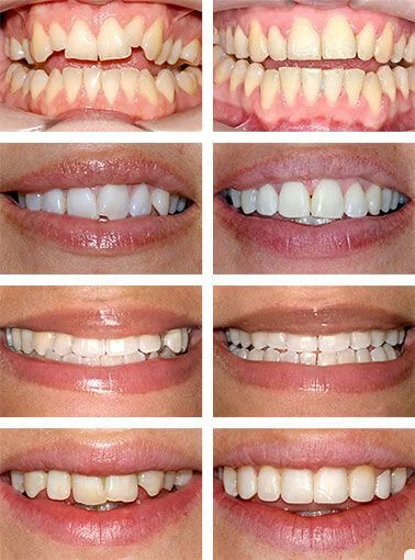 نمونه کار ارتودنسی دکتر نگین اثنی عشری