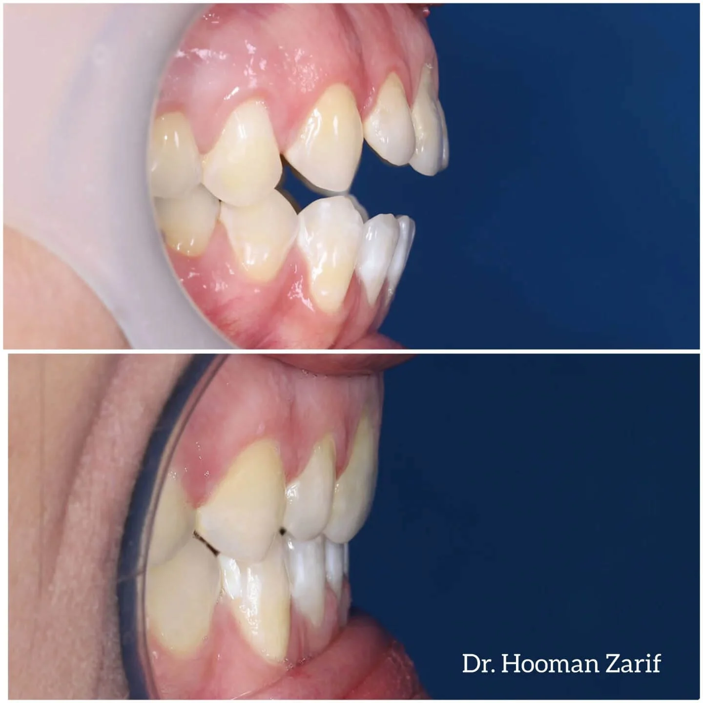 نمونه کار ارتودنسی دکتر هومن ظریف