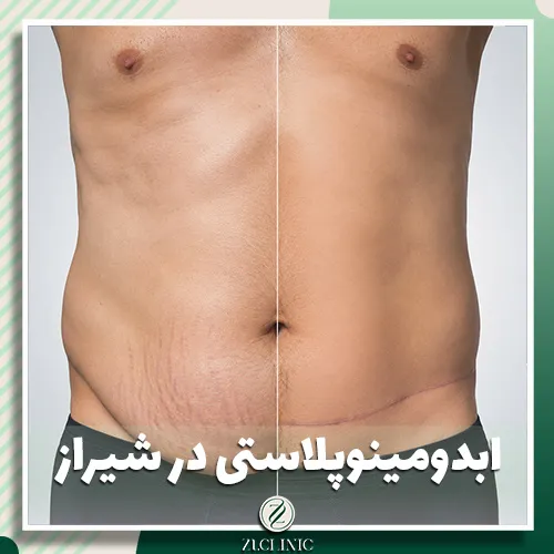 ابدومینوپلاستی در شیراز