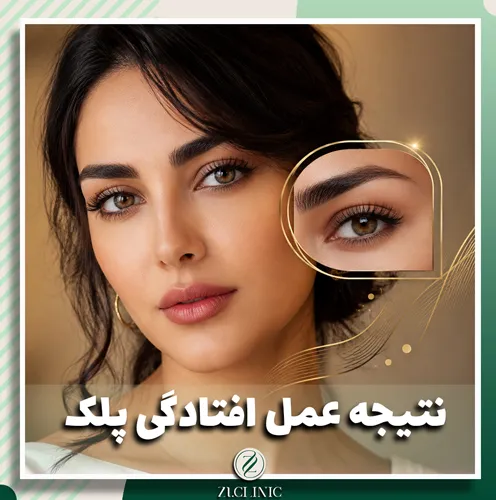 تصویر نشان دهنده نتیجه عمل افتادگی پلک در شیراز برای خانم 39 ساله